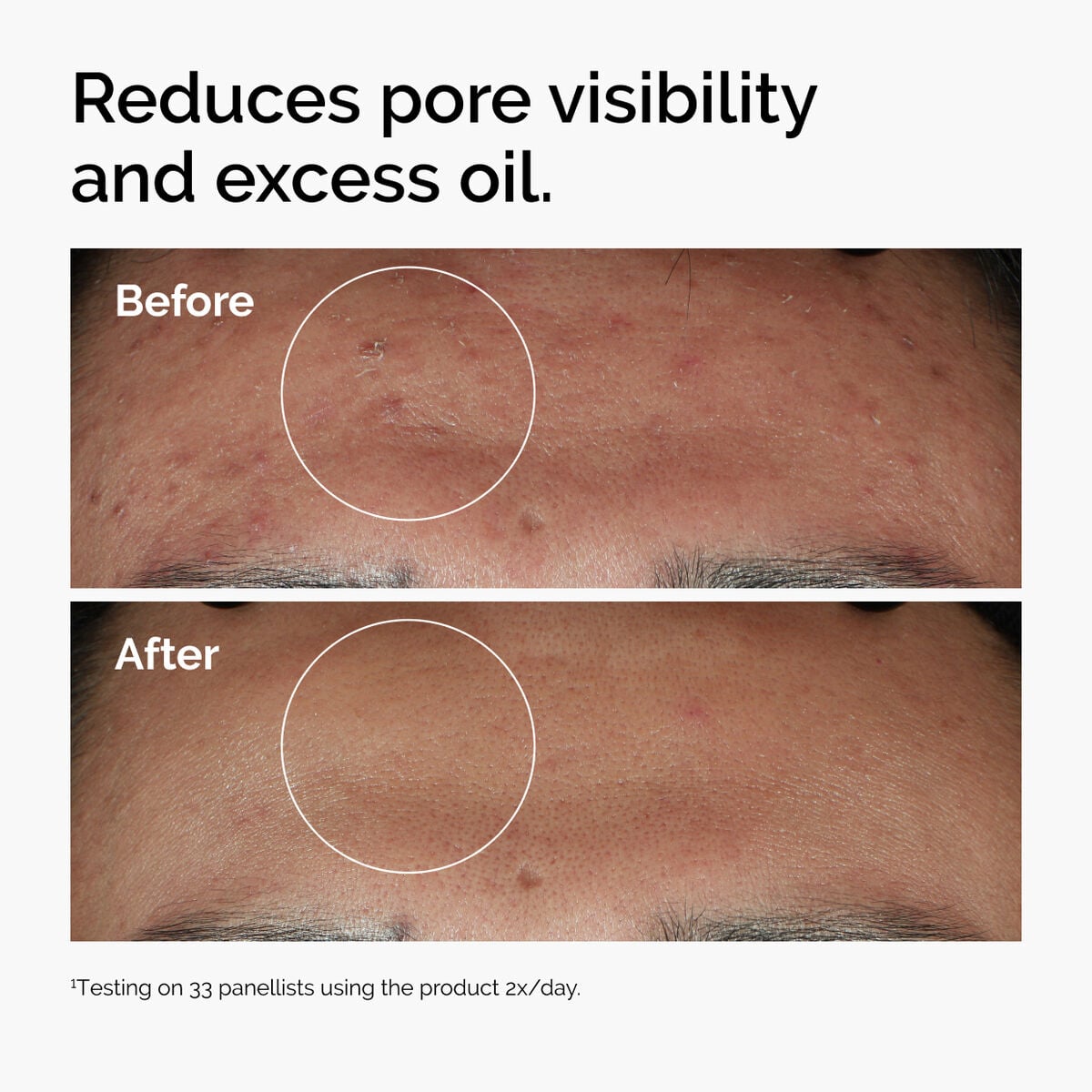 niacinamide-10-zinc-1-x2 ord-niacinamide-zinc-blemish-serum-before-after-pores.jpg