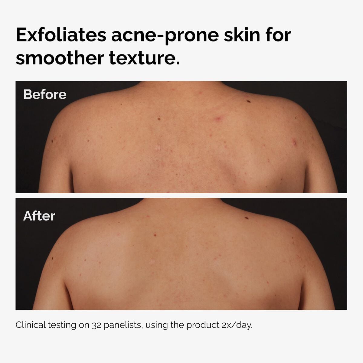 salicylic-acid-0-5-body-serum-t6 ord-salicylic-acid-body-serum-before-after-graphic-NA.jpg