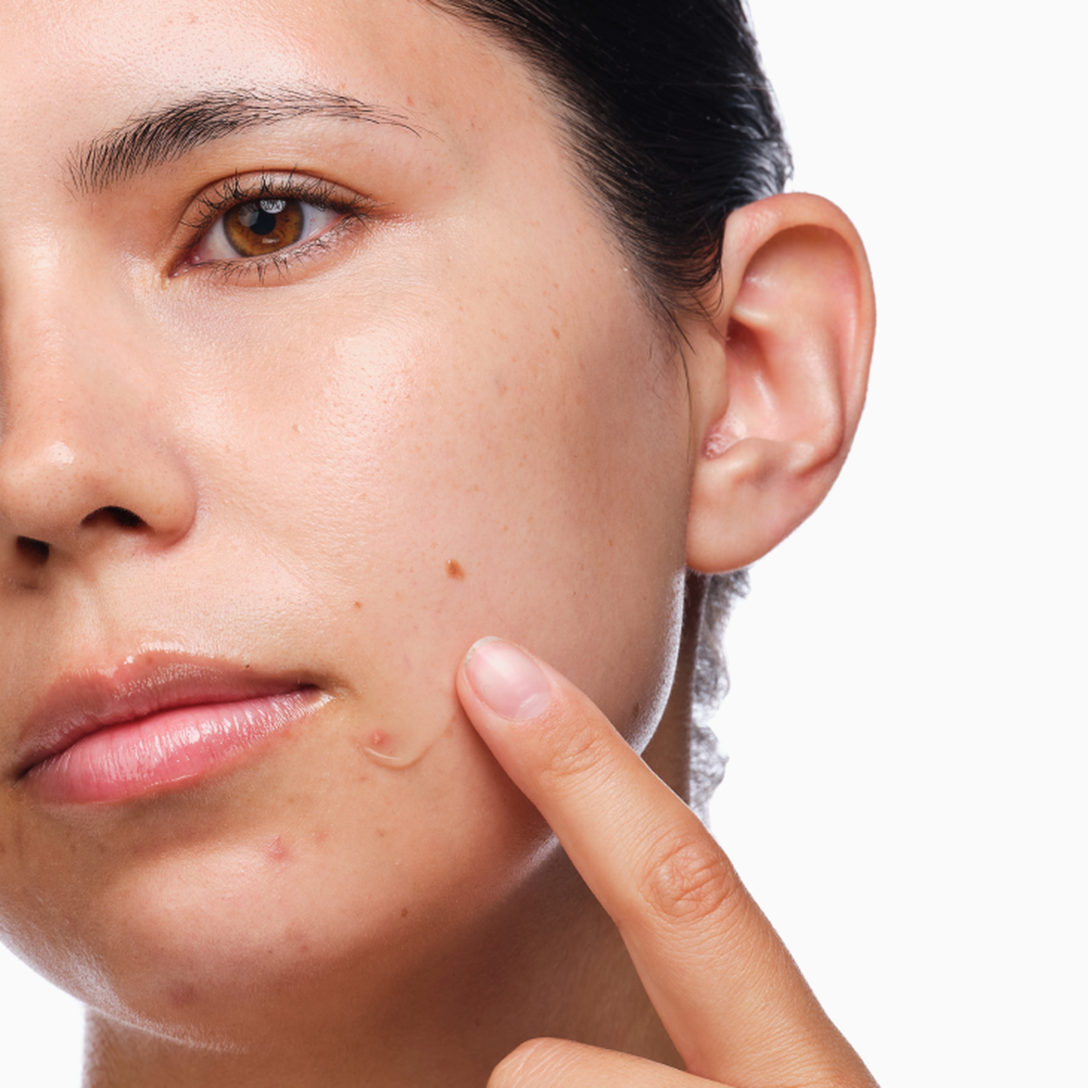 the-acne-set-g3 rdn-the-acne-set-application.png